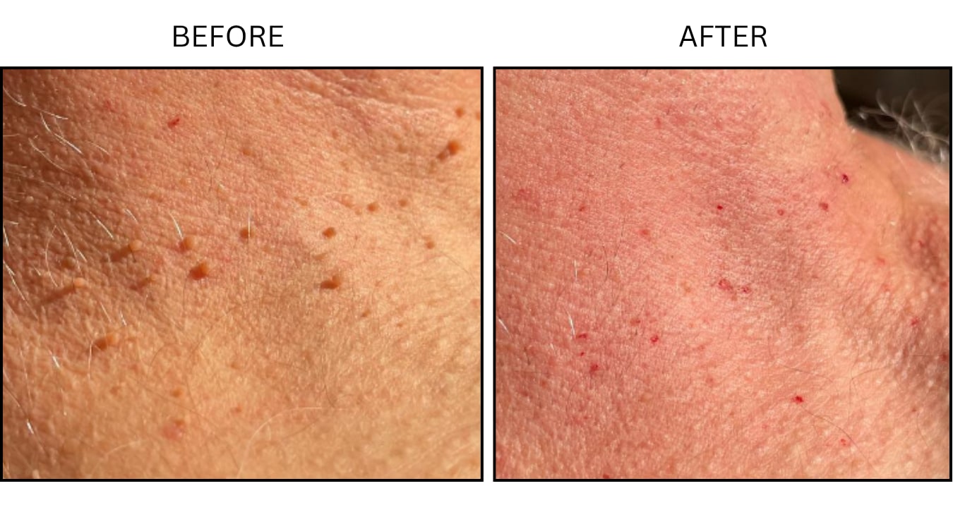 Skin Tags (Surgical (benign Destruction)), before and after photograph 1