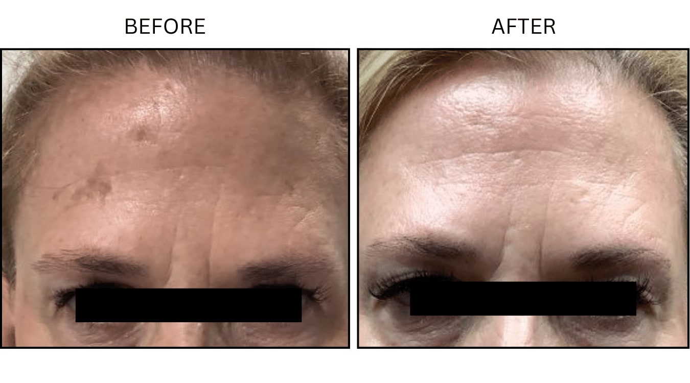 Sun Freckles And Spots (Medical), before and after photograph 2