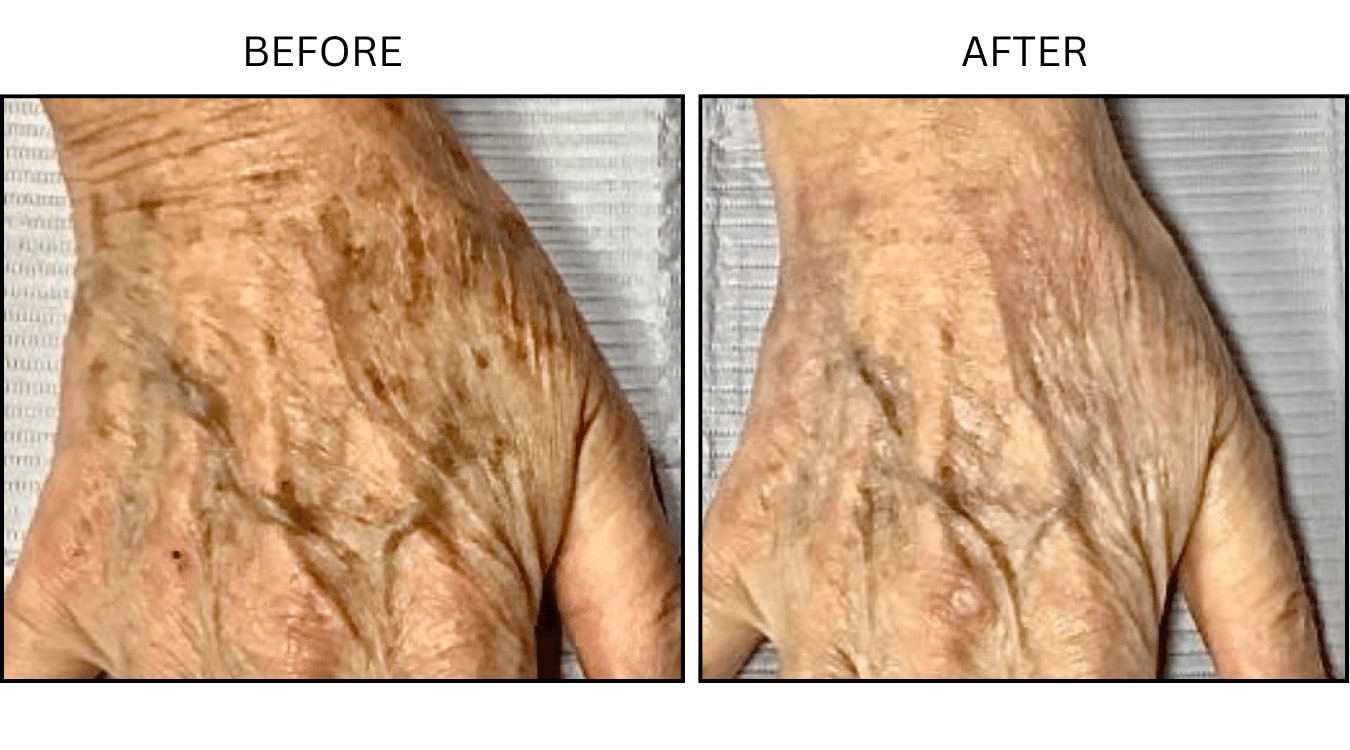 Sun Freckles And Spots (Medical), before and after photograph 3