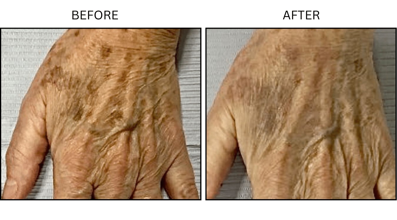 Sun Freckles And Spots (Medical), before and after photograph 4