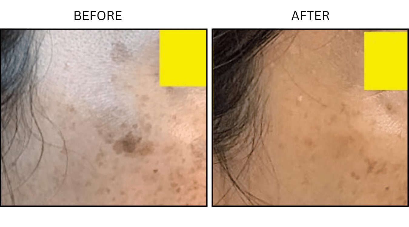 Sun Freckles And Spots (Medical), before and after photograph 1