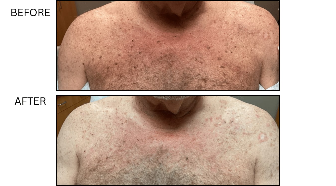 Sun Freckles And Spots (Medical), before and after photograph 5