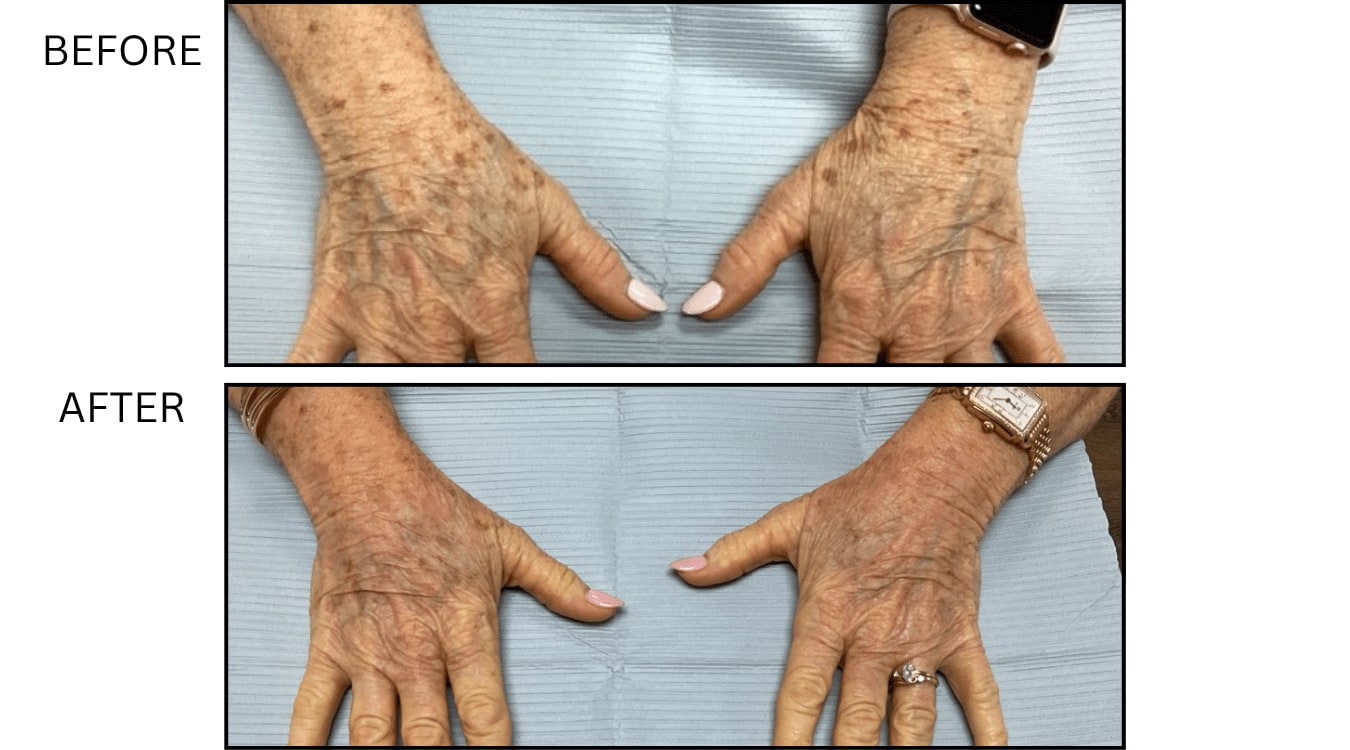 Sun Freckles And Spots (Medical), before and after photograph 6