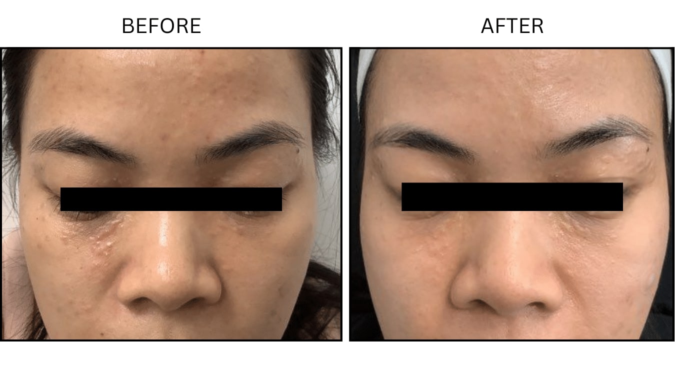 Syringomas (Medical), before and after photograph 1