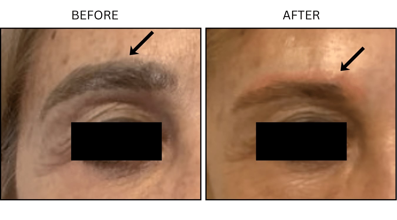 Tattoo Removal (Lasers), before and after photograph 2