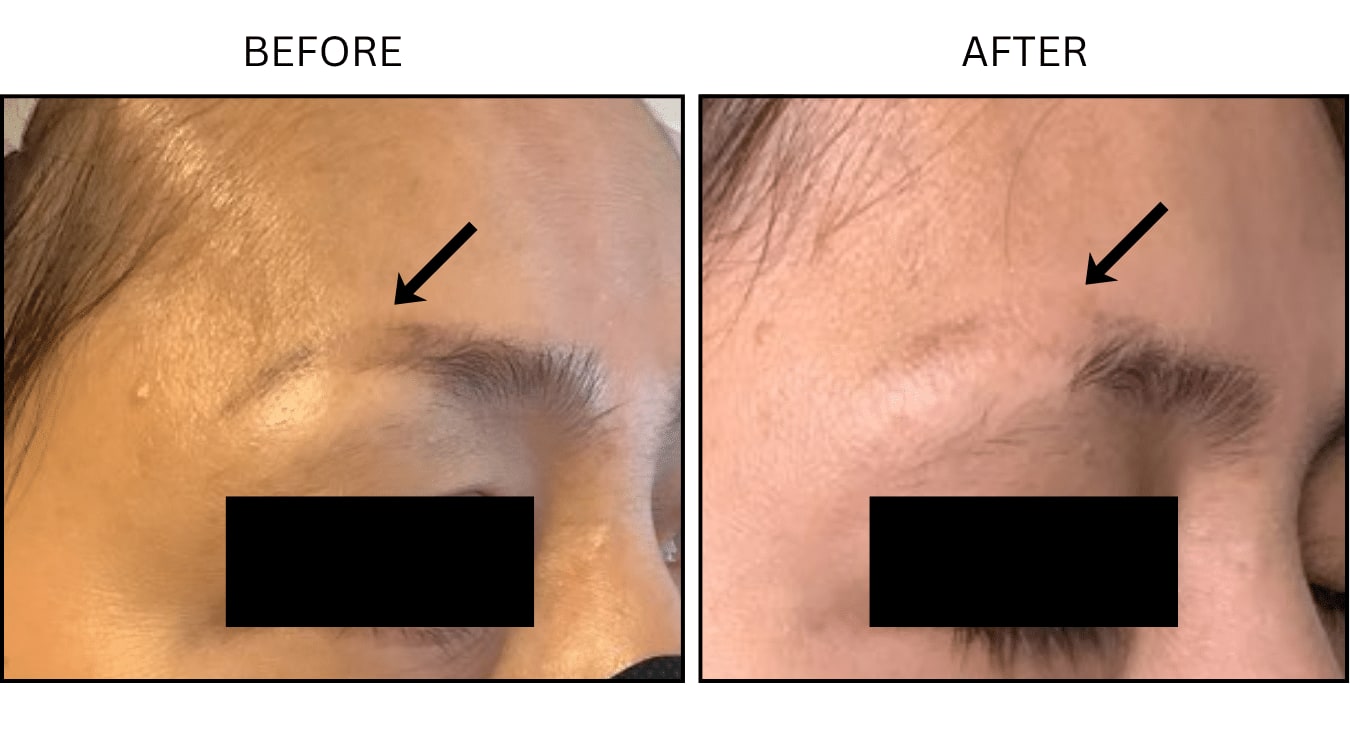 Tattoo Removal (Lasers), before and after photograph 3