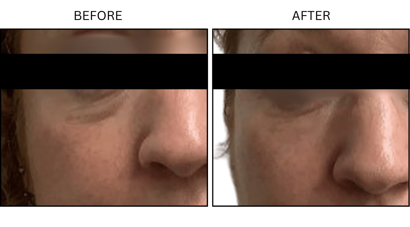 Under Eyes (Fillers), before and after photograph 2