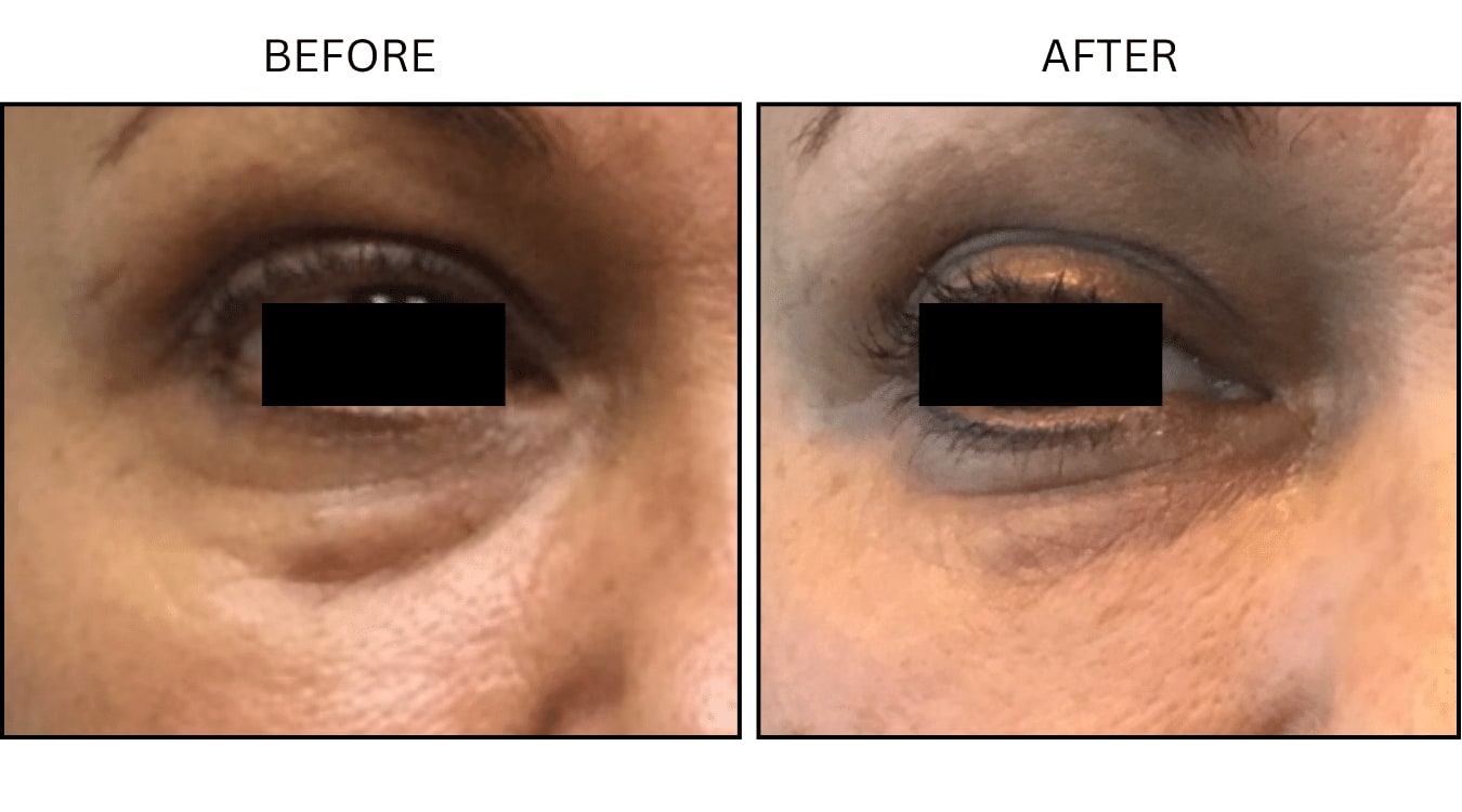 Under Eyes (Fillers), before and after photograph 16