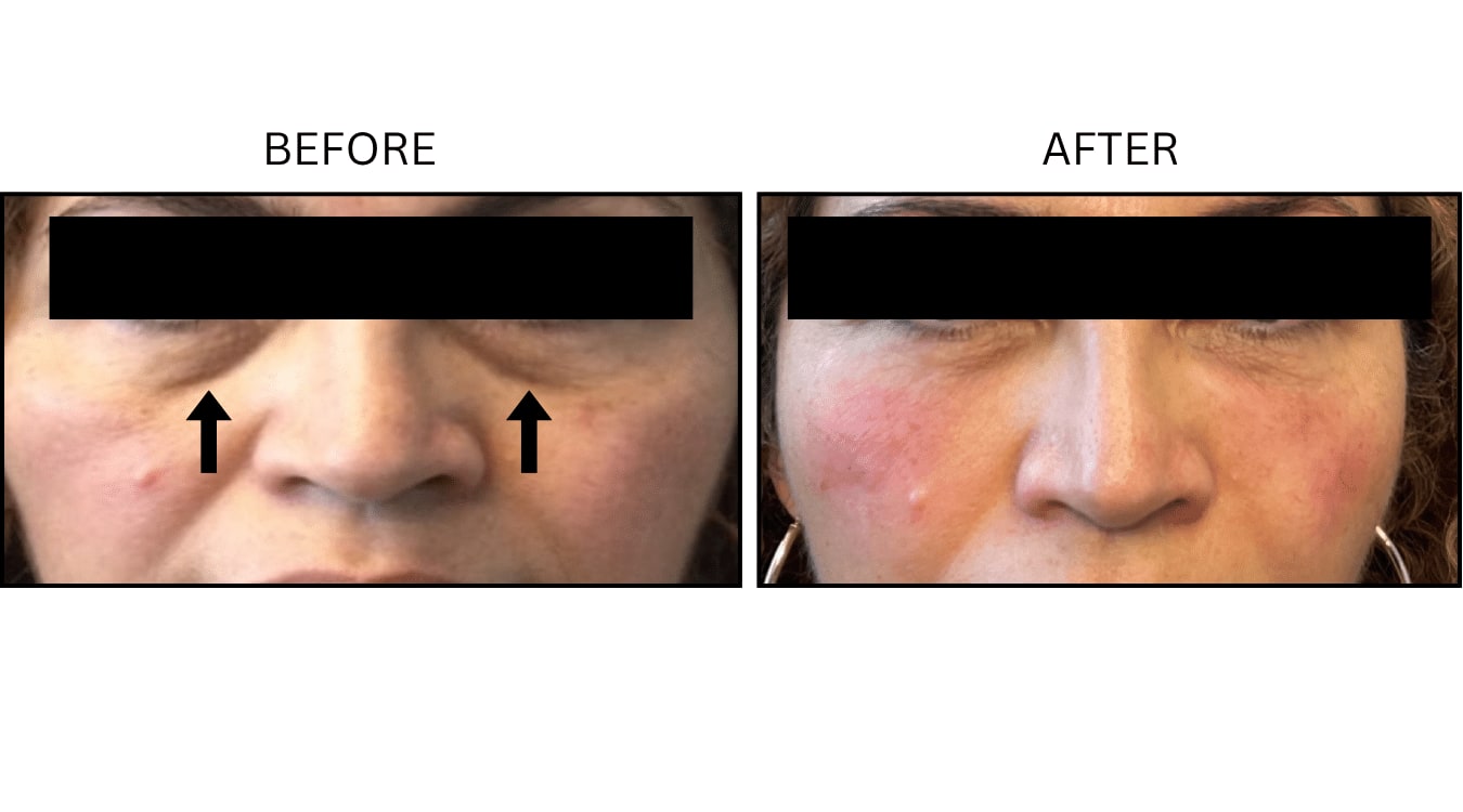 Under Eyes (Fillers), before and after photograph 9