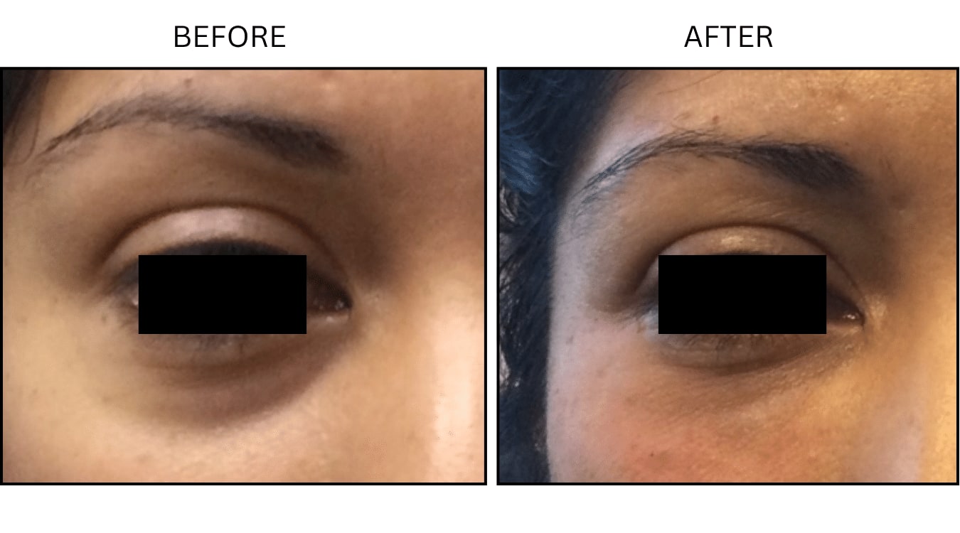 Under Eyes (Fillers), before and after photograph 11