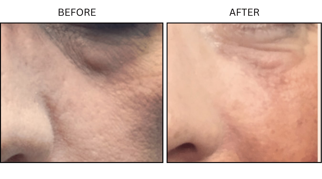 Under Eyes (Fillers), before and after photograph 12