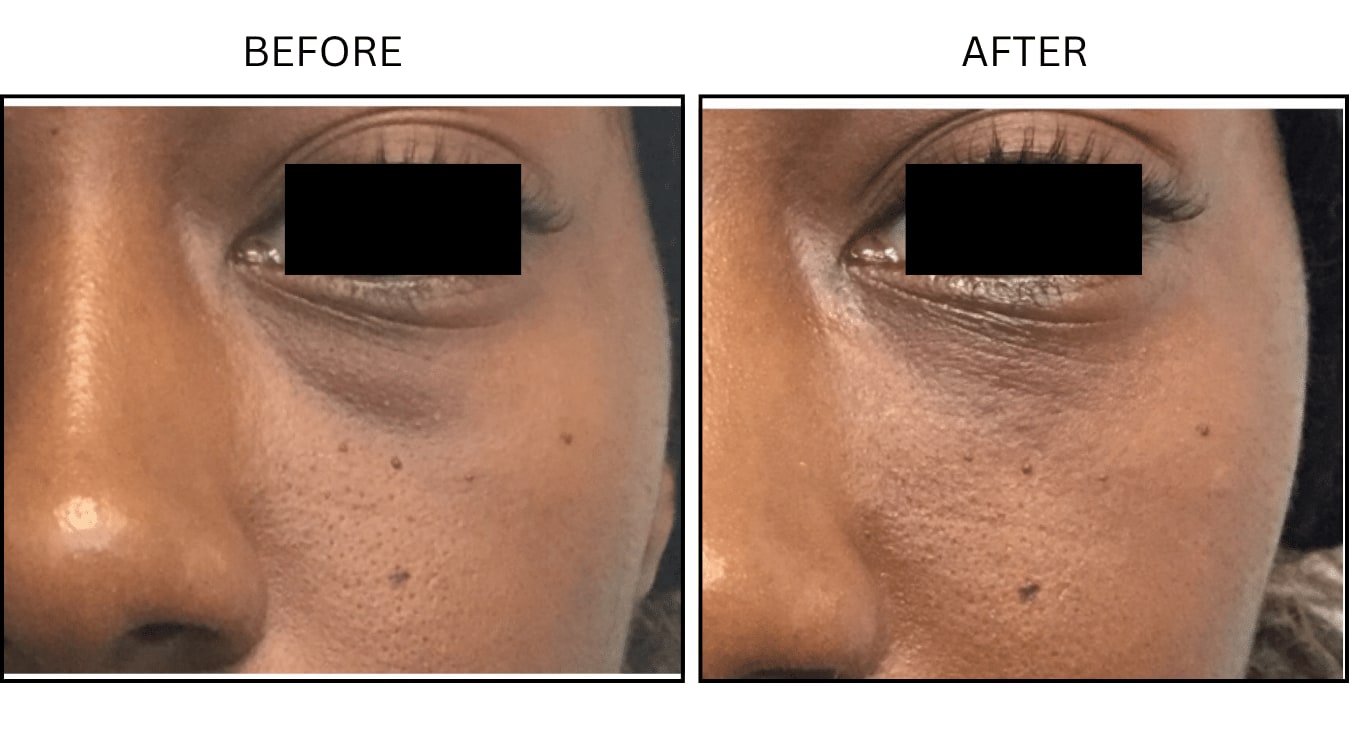 Under Eyes (Fillers), before and after photograph 13
