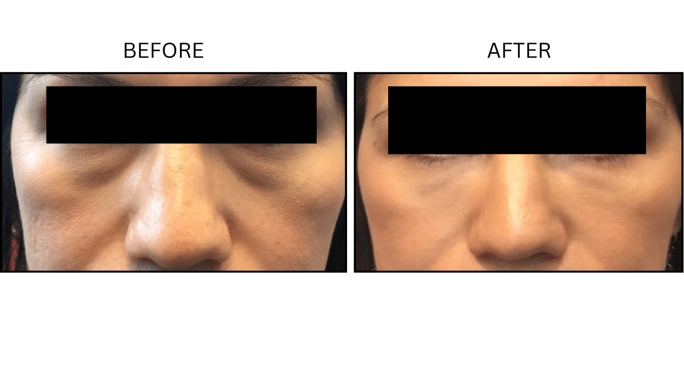 Under Eyes (Fillers), before and after photograph 10