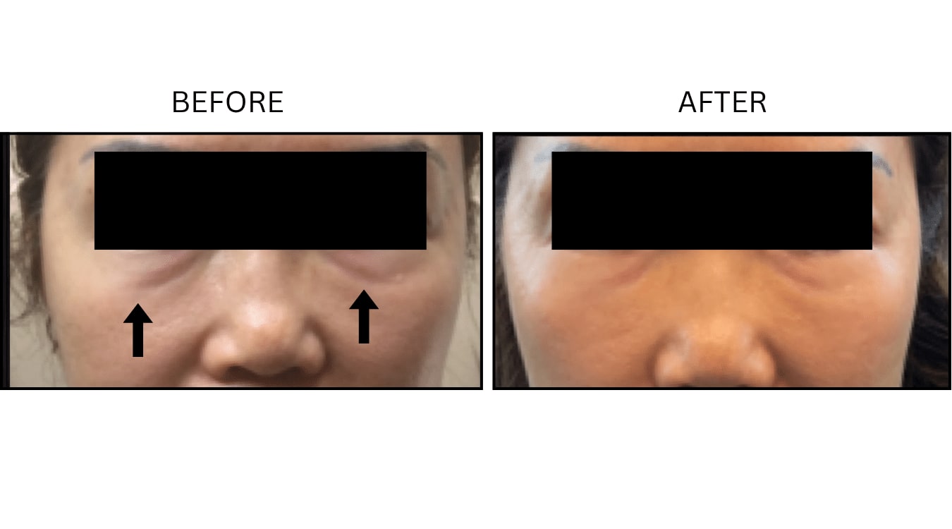 Under Eyes (Fillers), before and after photograph 8