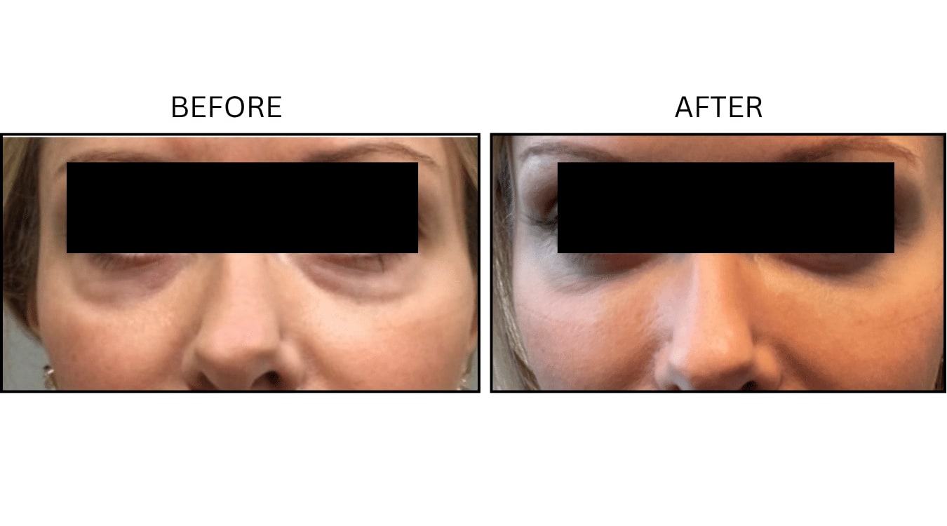 Under Eyes (Fillers), before and after photograph 14