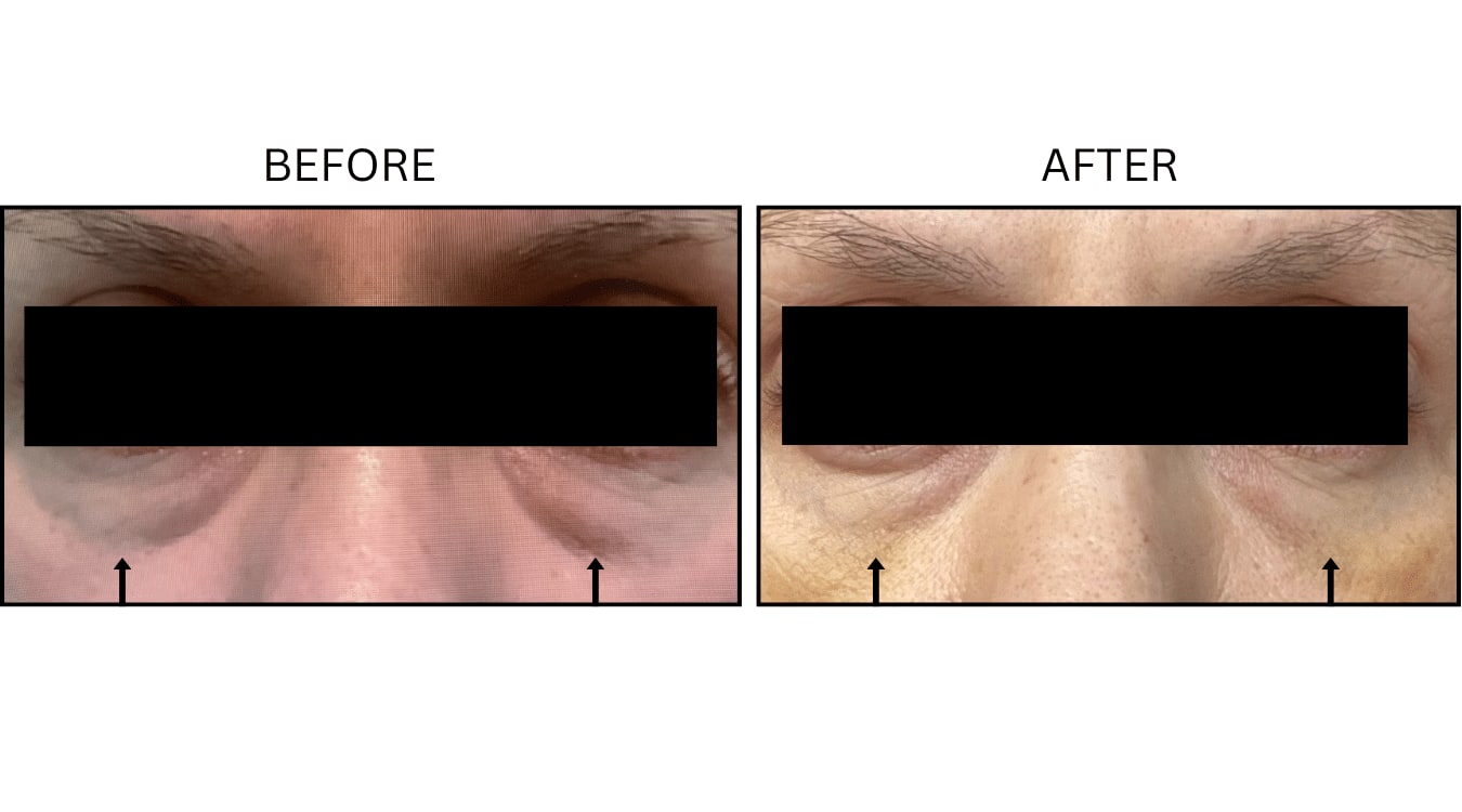 Under Eyes (Fillers), before and after photograph 17