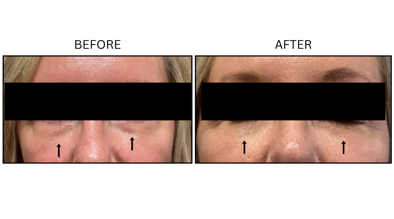 Under Eyes (Fillers), before and after photograph 18