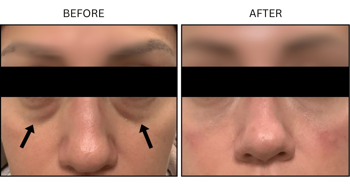 Under Eyes (Fillers), before and after photograph 7