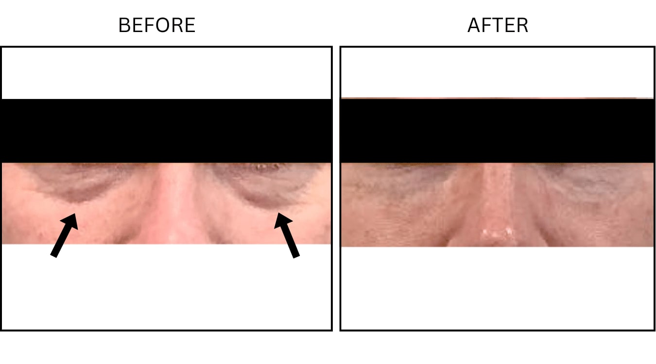 Under Eyes (Fillers), before and after photograph 1