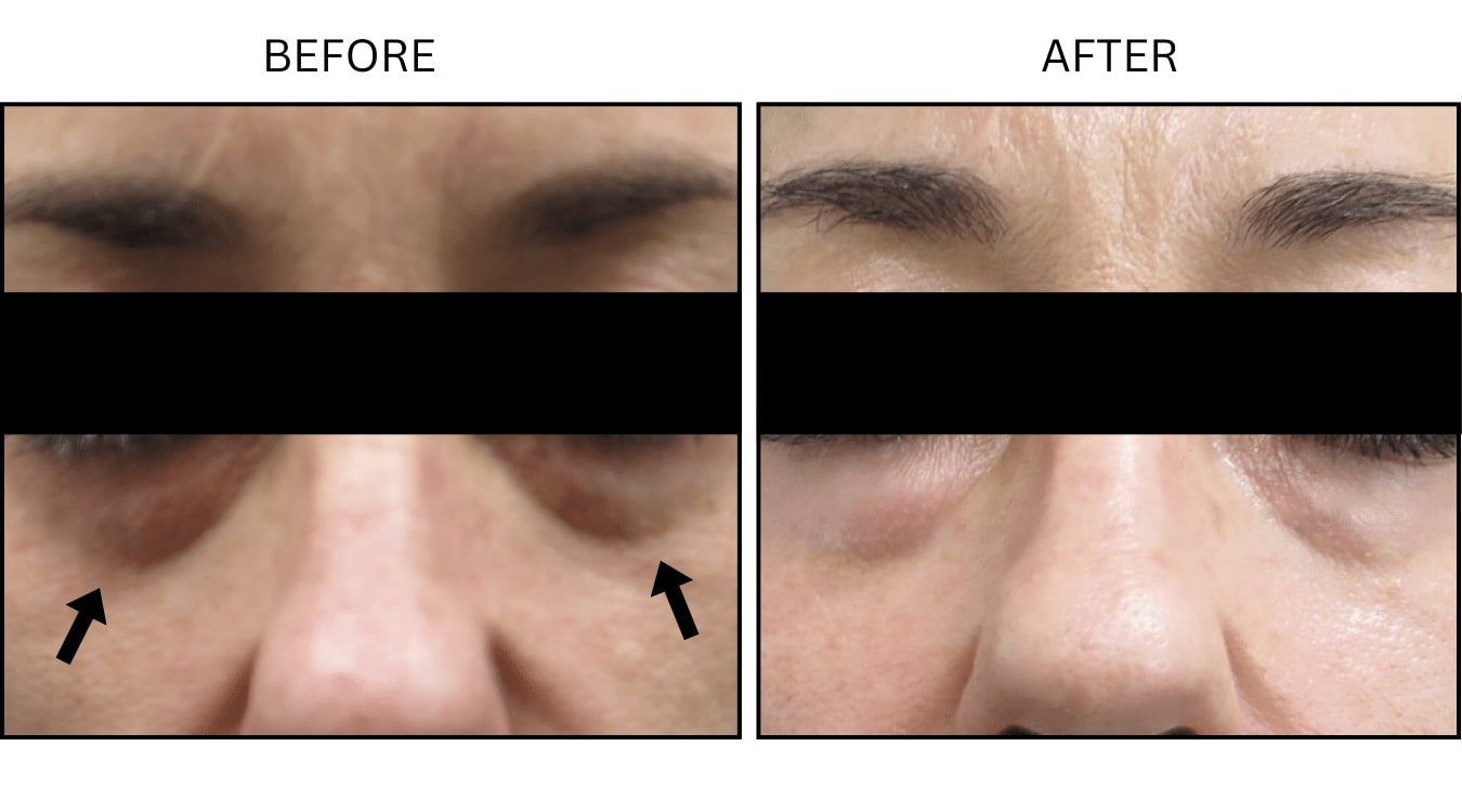 Under Eyes (Fillers), before and after photograph 6