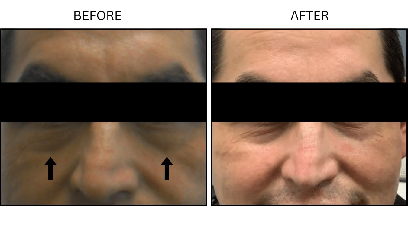 Under Eyes (Fillers), before and after photograph 5