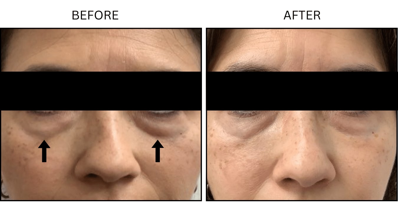 Under Eyes (Fillers), before and after photograph 3
