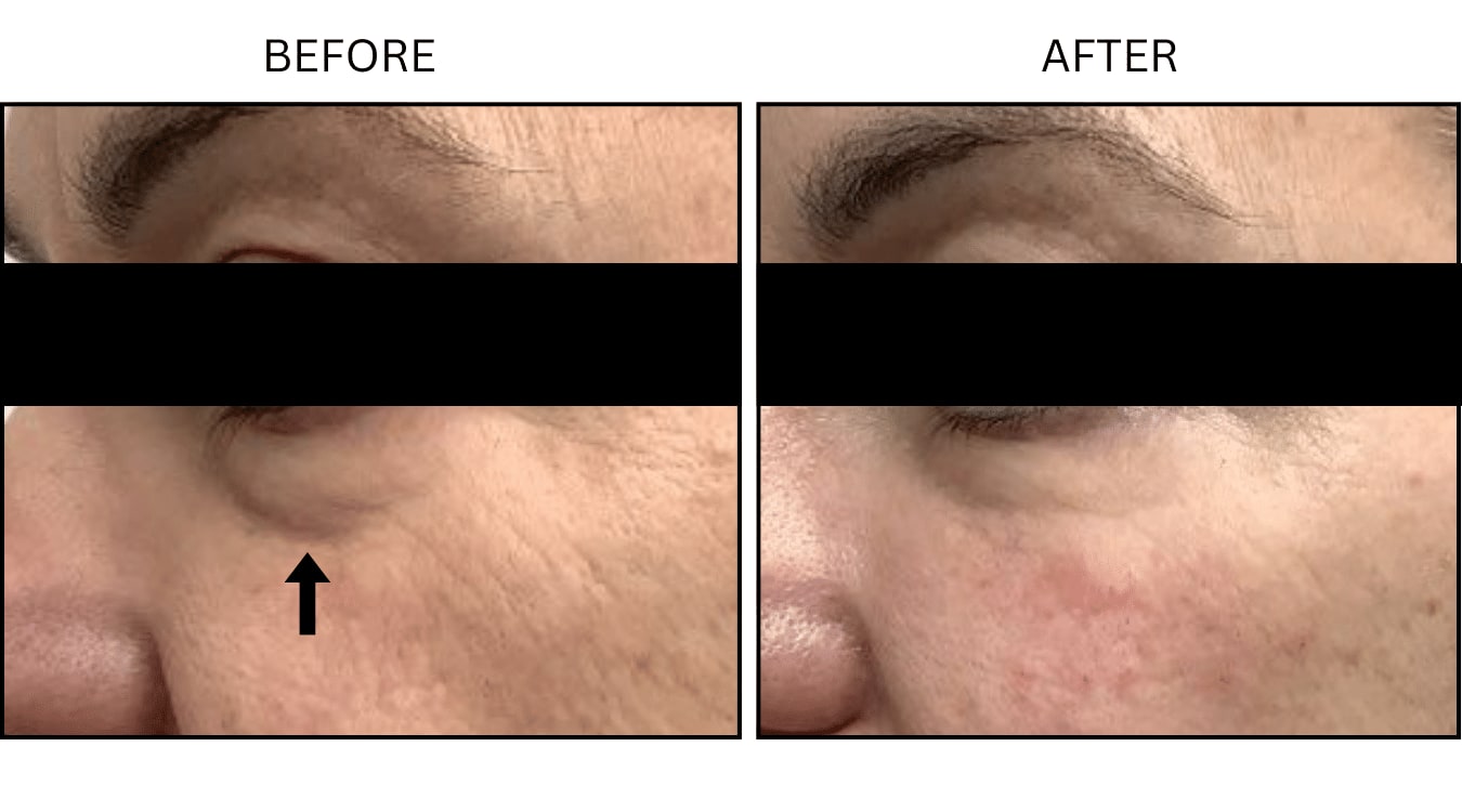 Under Eyes (Fillers), before and after photograph 4