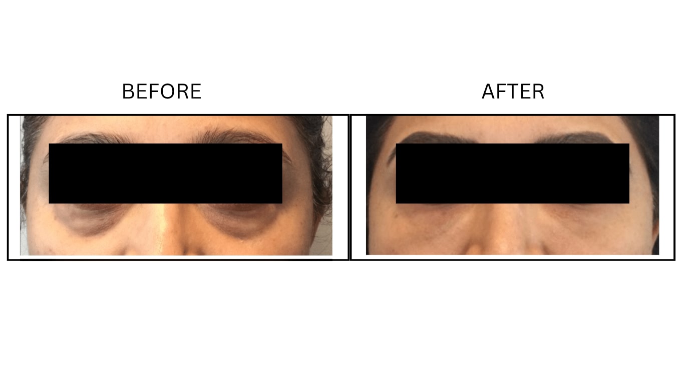 Under Eyes (Fillers), before and after photograph 15