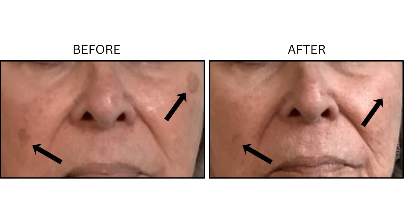 VBeam (Lasers), before and after photograph 5