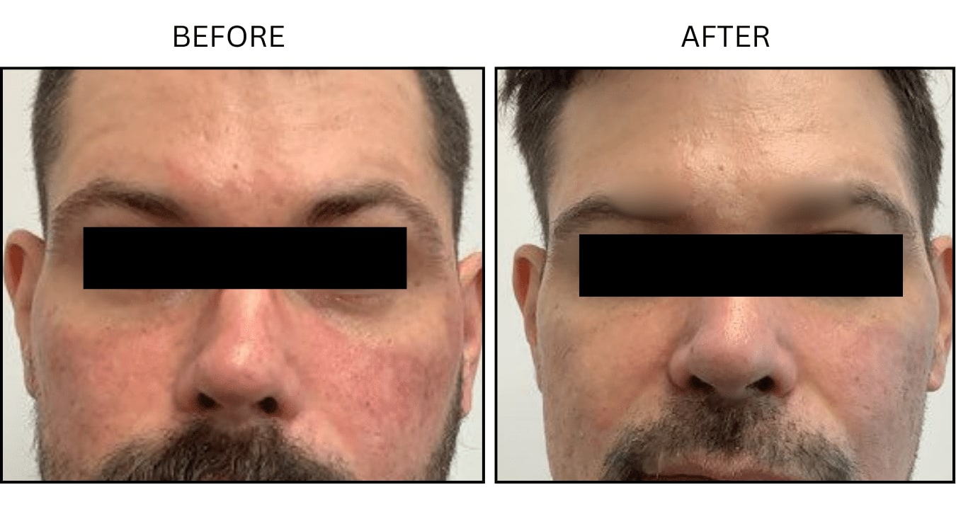 VBeam (Lasers), before and after photograph 1
