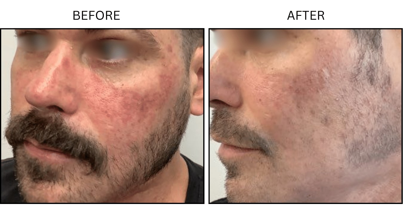 VBeam (Lasers), before and after photograph 2