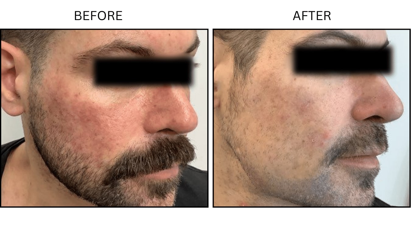 VBeam (Lasers), before and after photograph 3