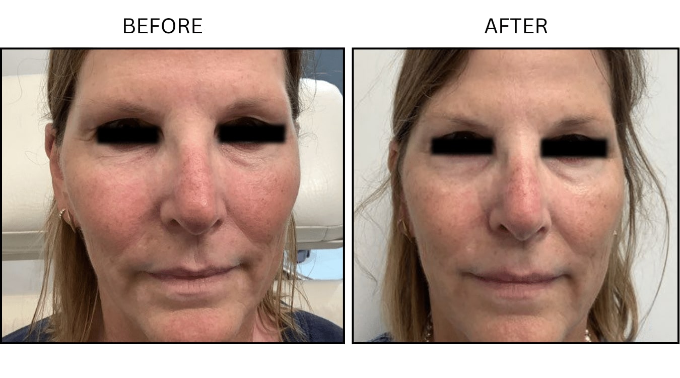 VBeam (Lasers), before and after photograph 4