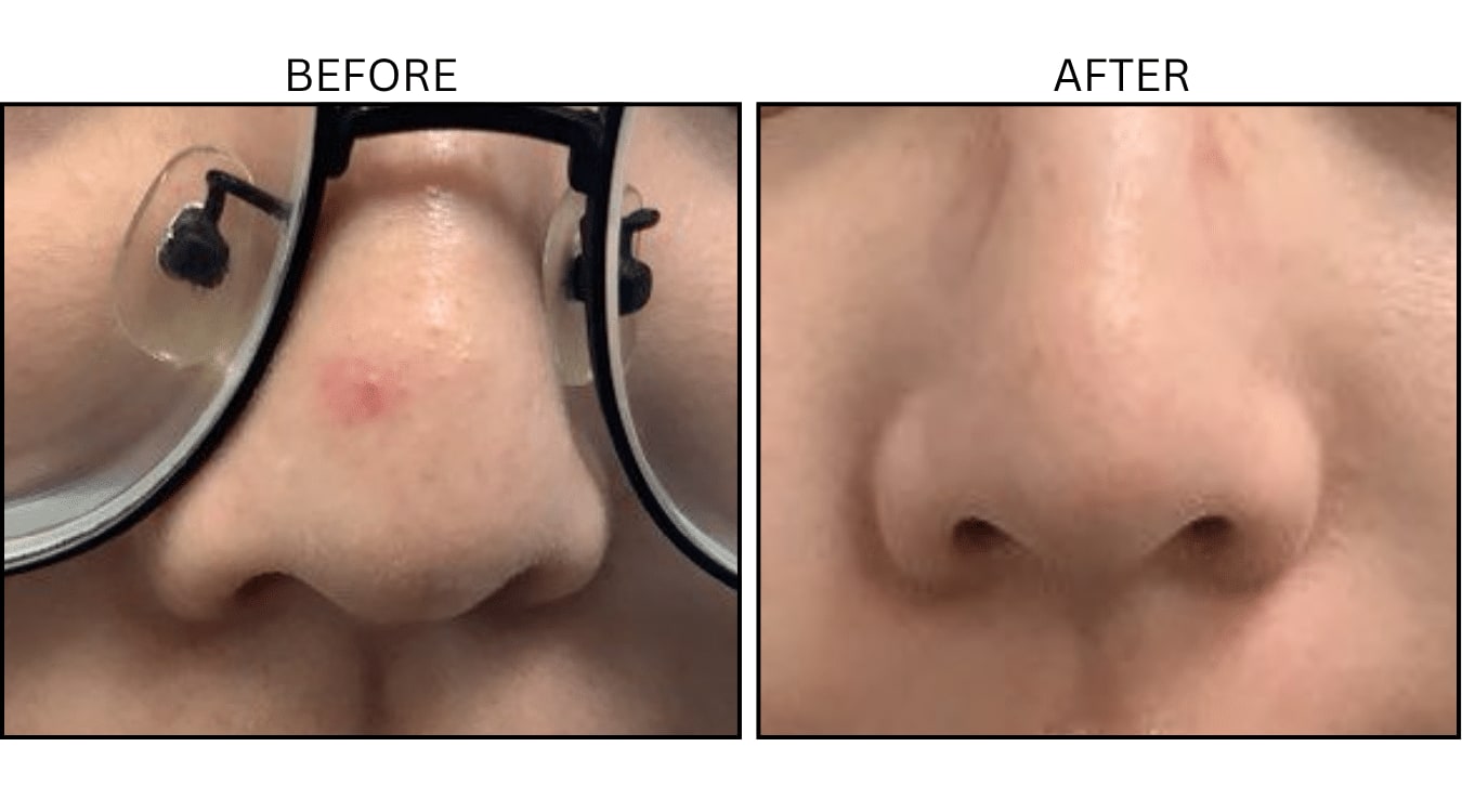 VBeam (Lasers), before and after photograph 6