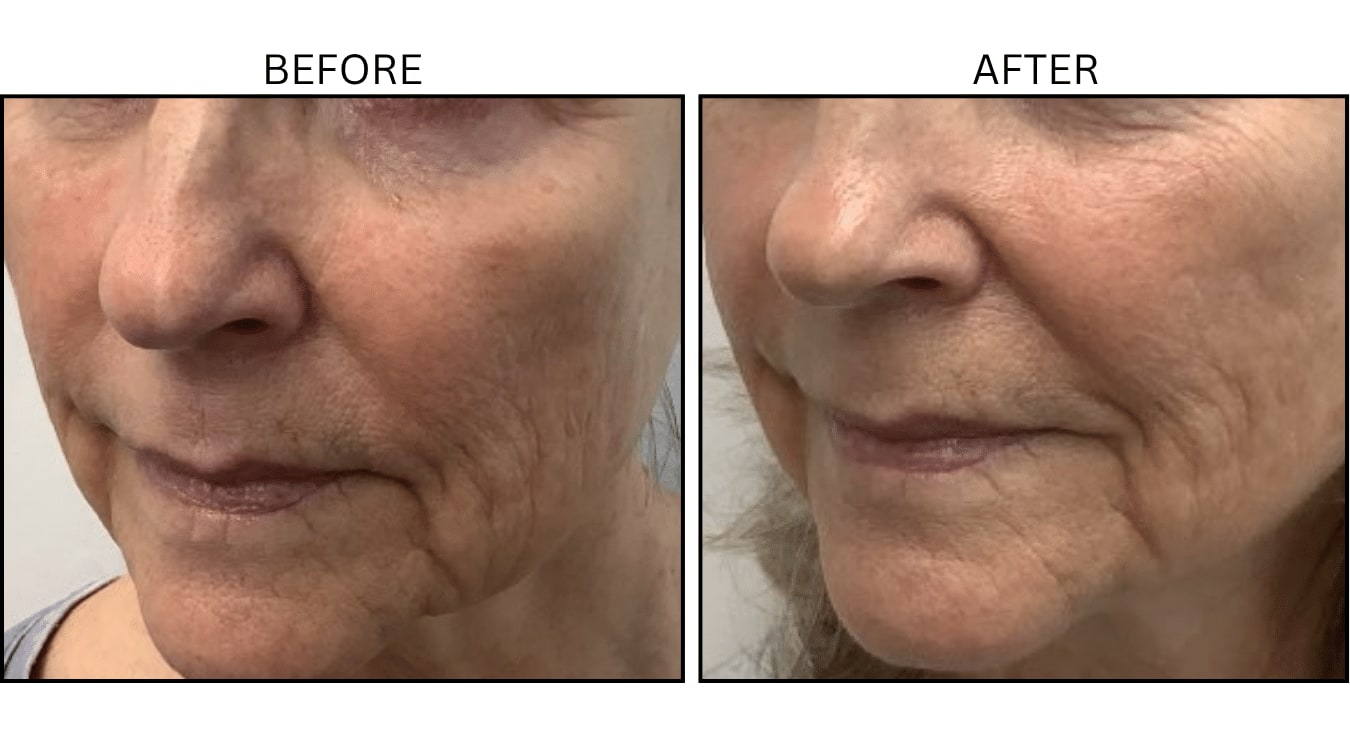 VBeam (Lasers), before and after photograph 7