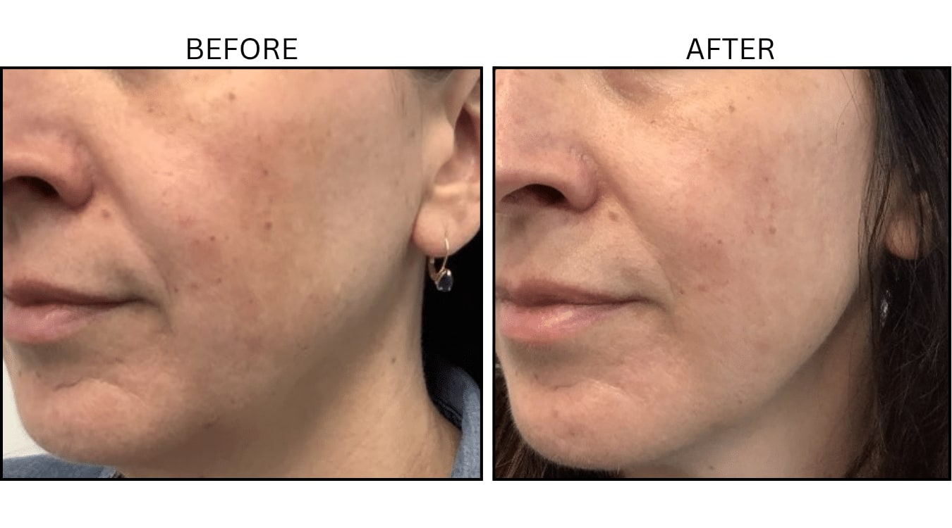 VBeam (Lasers), before and after photograph 8