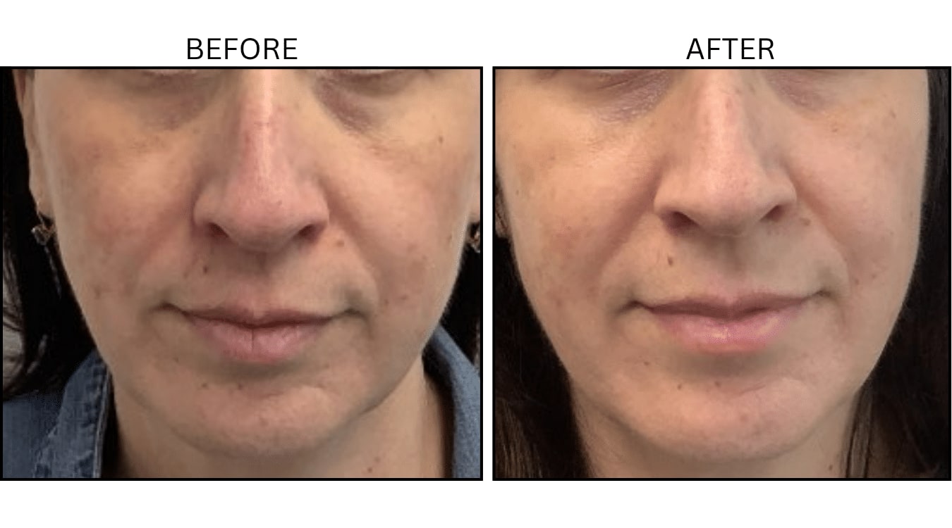 VBeam (Lasers), before and after photograph 9