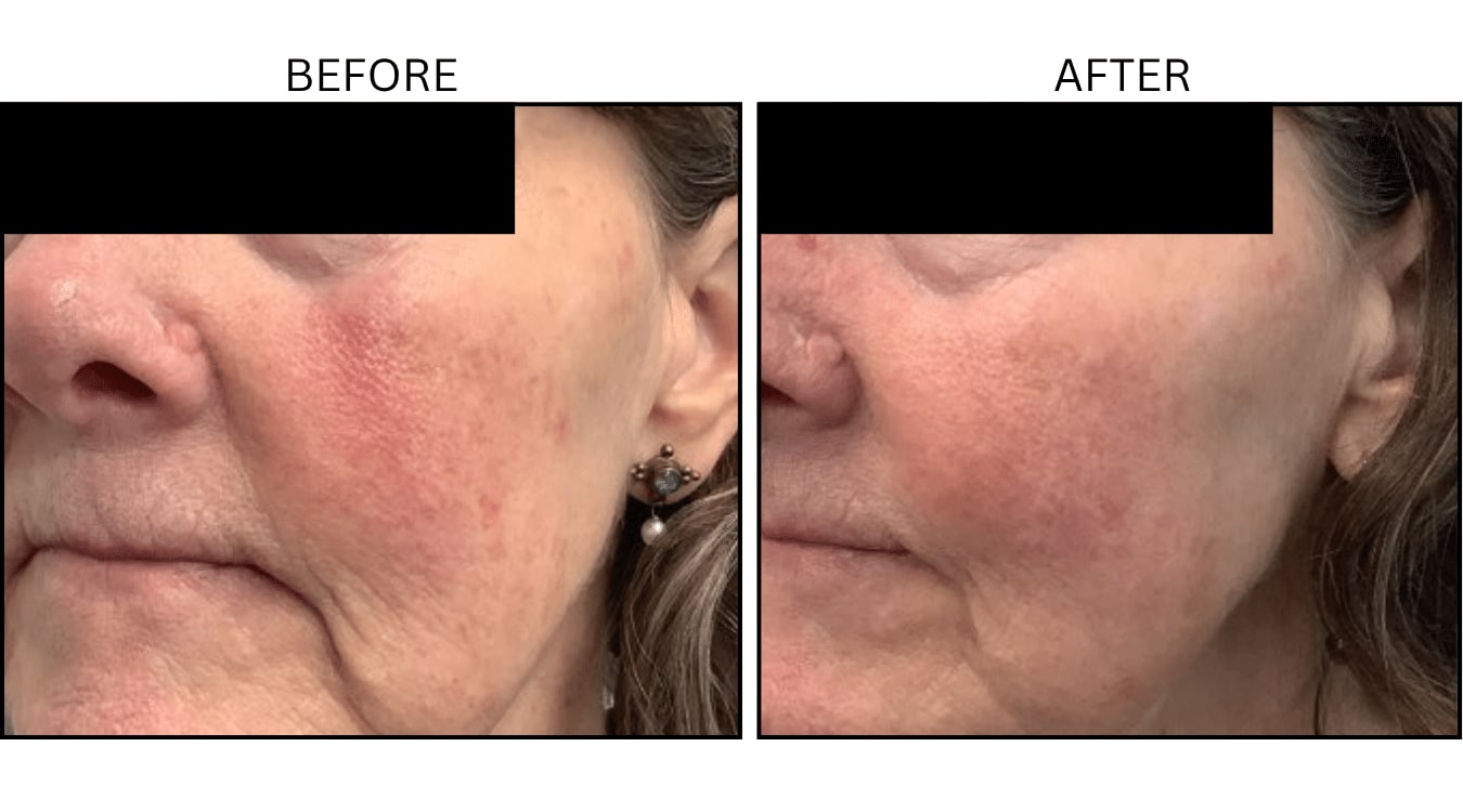 VBeam (Lasers), before and after photograph 10