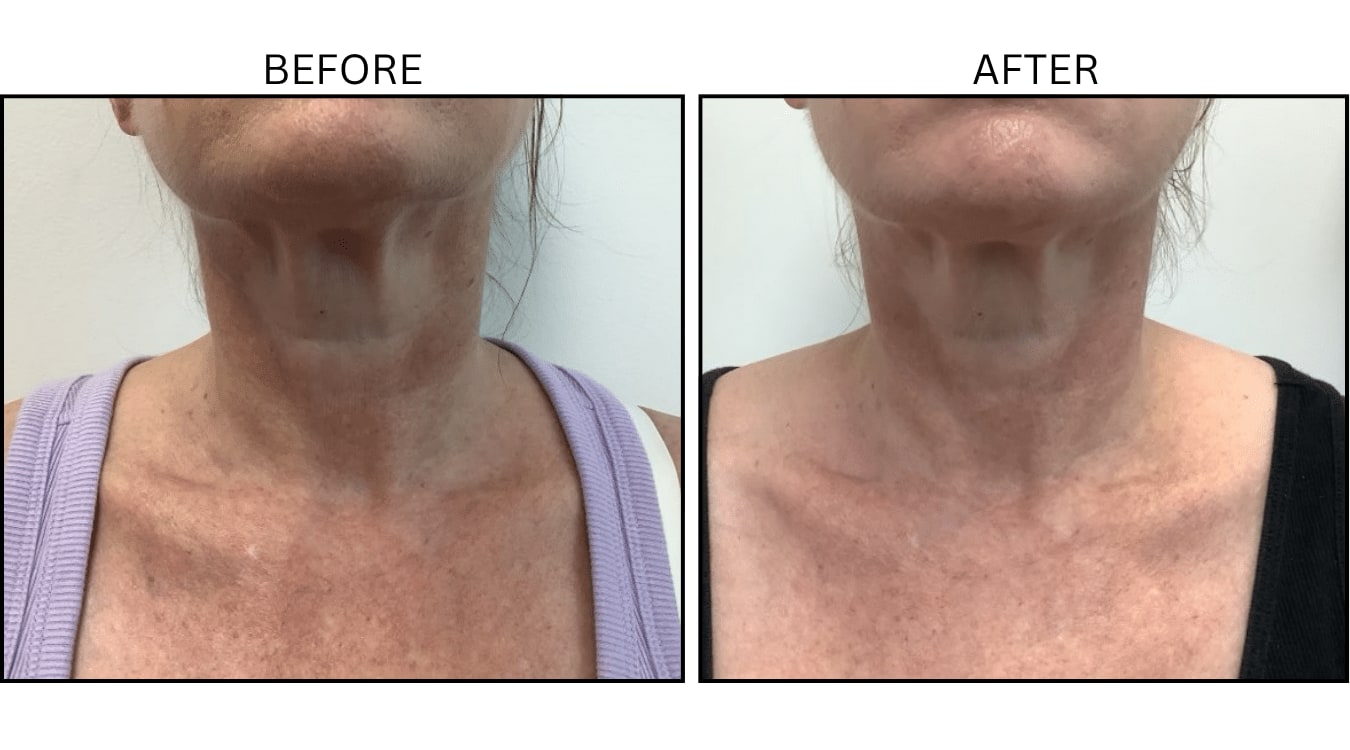 VBeam (Lasers), before and after photograph 12