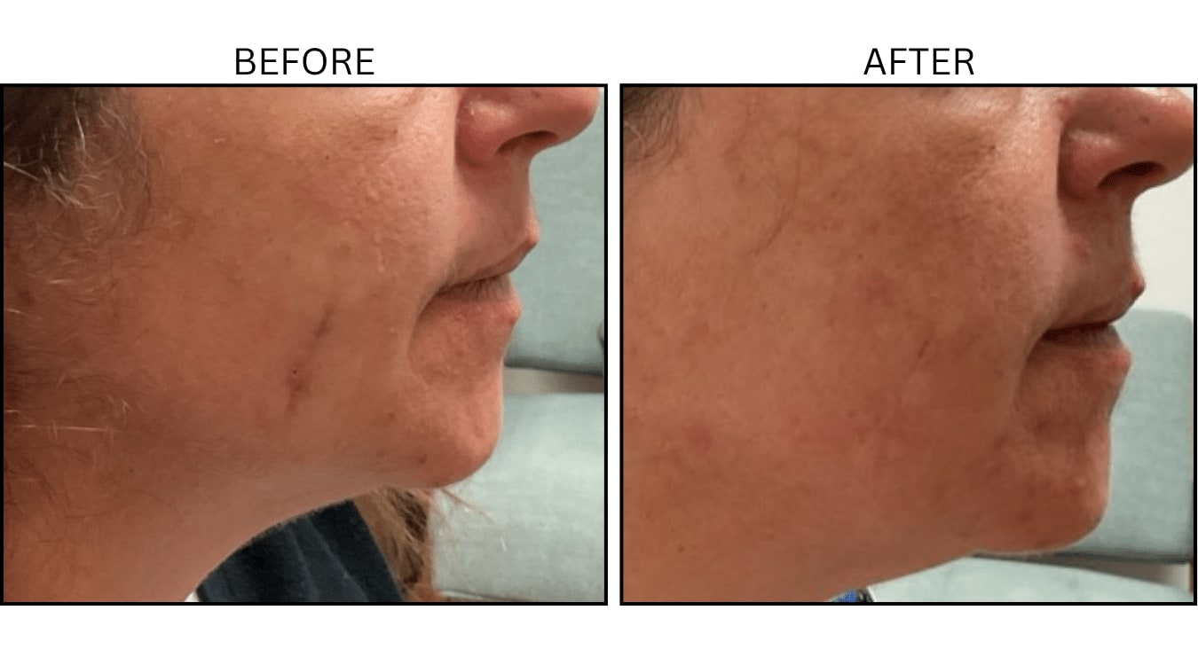 VBeam (Lasers), before and after photograph 13