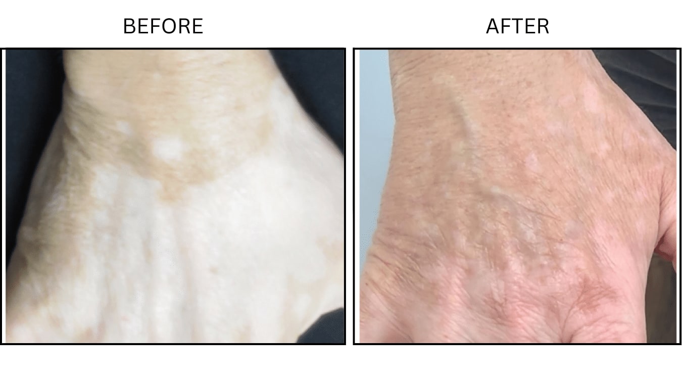 Vitiligo (Medical), before and after photograph 1