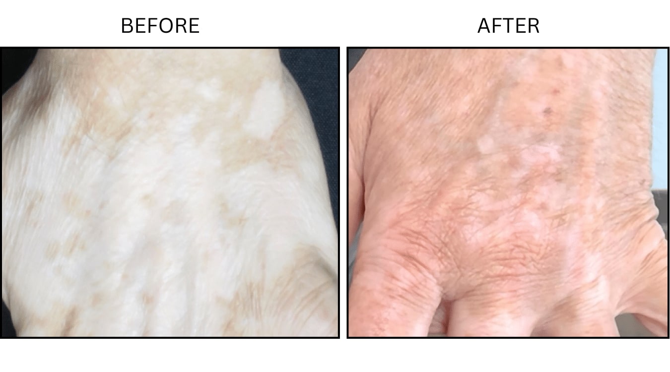 Vitiligo (Medical), before and after photograph 3