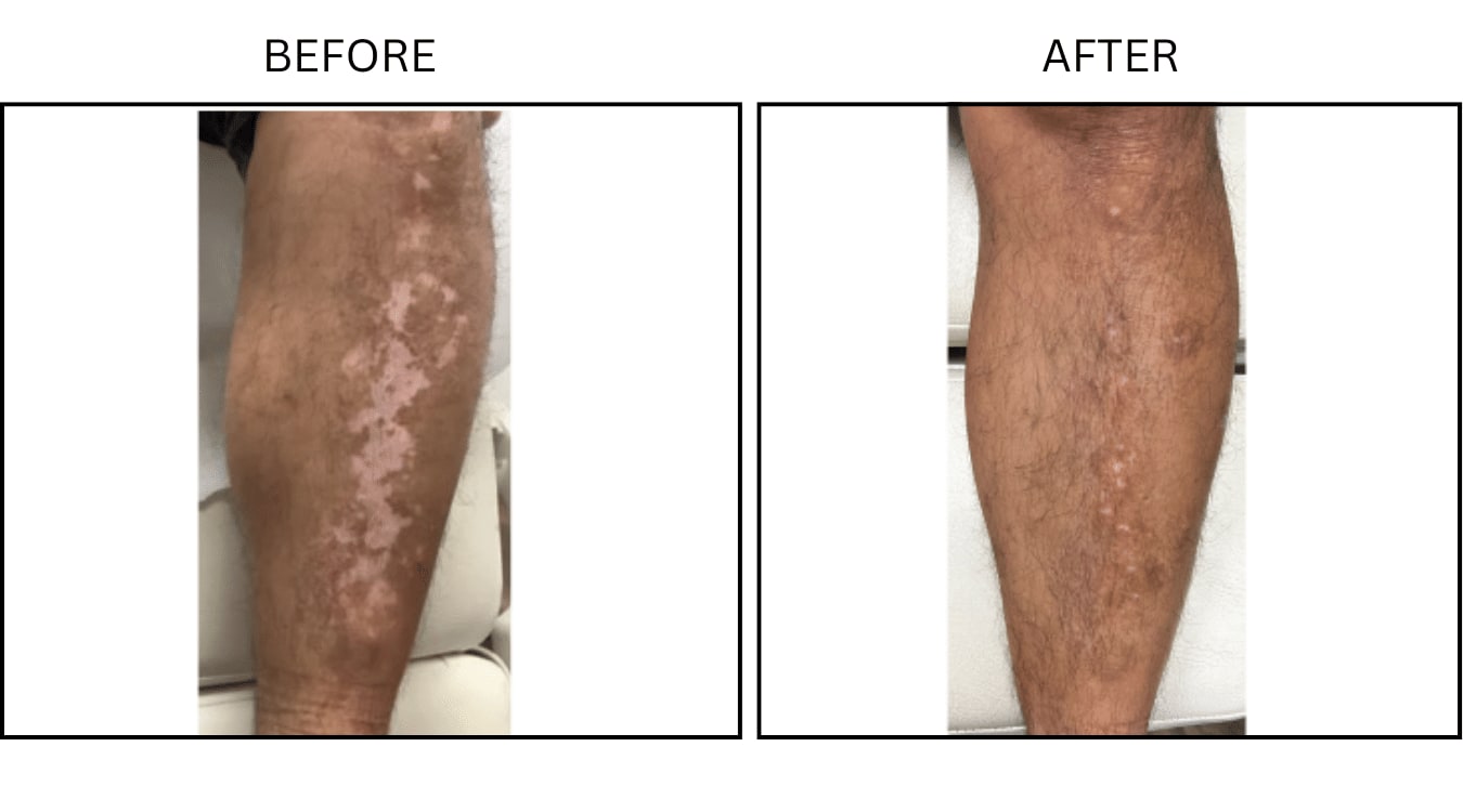 Vitiligo (Medical), before and after photograph 2