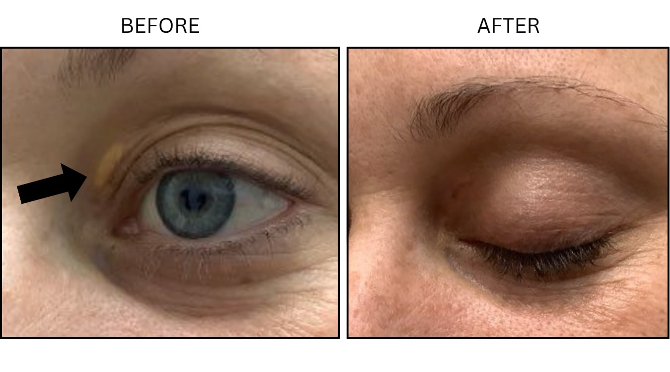 Xanthelasma (Surgical (benign Destruction)), before and after photograph 1