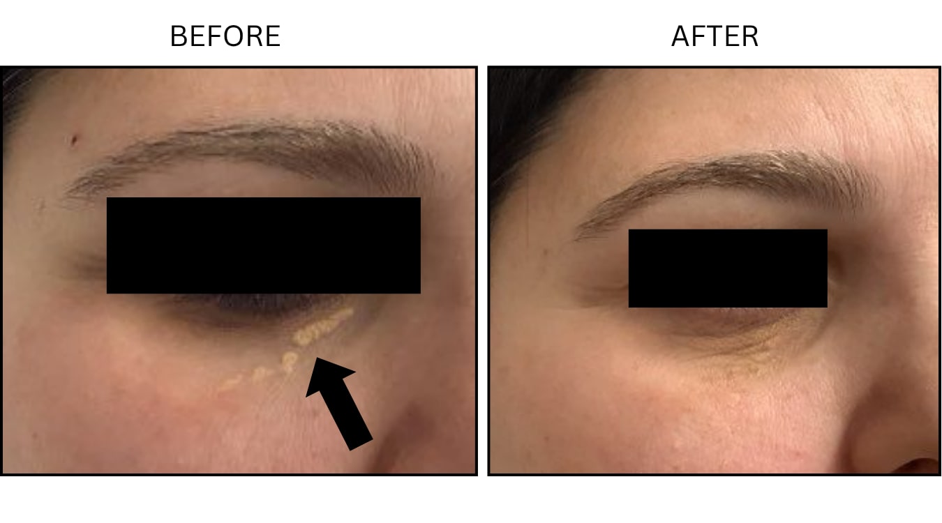 Xanthelasma (Surgical (benign Destruction)), before and after photograph 2