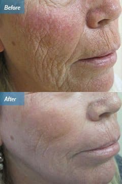 Laser Skin Resurfacing Therapy Los Angeles CA