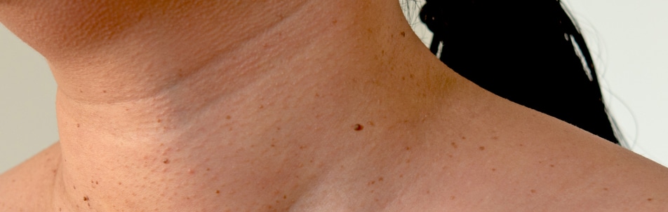 Skin Tag Treatment Los Angeles CA