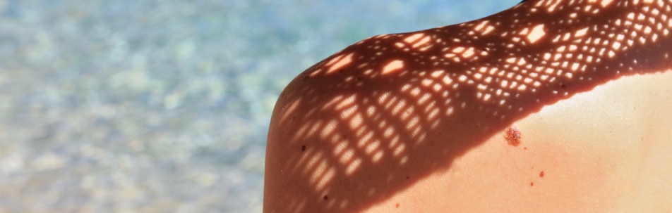 Sun Spots Treatment Los Angeles CA