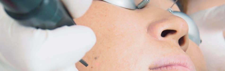 C02 Laser Resurfacing Los Angeles CA