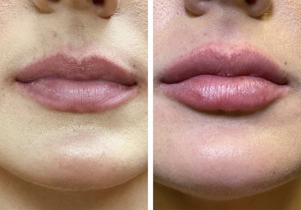 Lip Augmentation Treatment Los Angeles CA